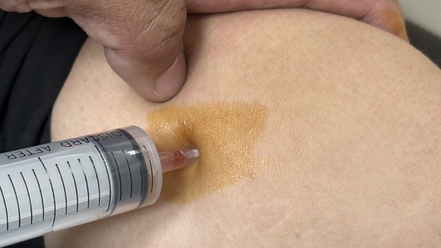 左膝反覆腫脹積水,配合口服藥物如免疫調節劑及消炎止痛藥治療。(圖/活力得中山脊椎外科醫院提供)